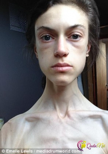 Anoreksiya xəstəsi olmuşdu - bir də son halını görün - FOTO