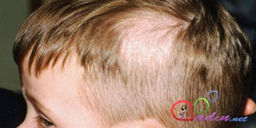 Uşaqlarda saç tökülməsinin səbəbləri