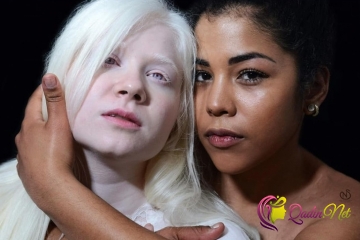 Albinosların qeyri-adi gözəlliyi