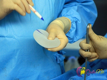 Silikon implant qoydurdu - Xərçəng oldu-FOTO