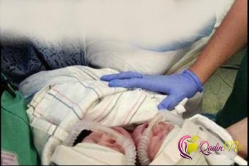NADIR HADİSƏ: İkibaşlı qız uşağı doğuldu